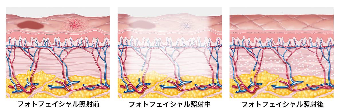 フォトフェイシャルの治療法